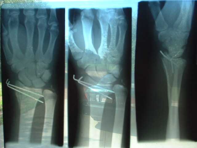 Sam Smith broken wrist x-rays